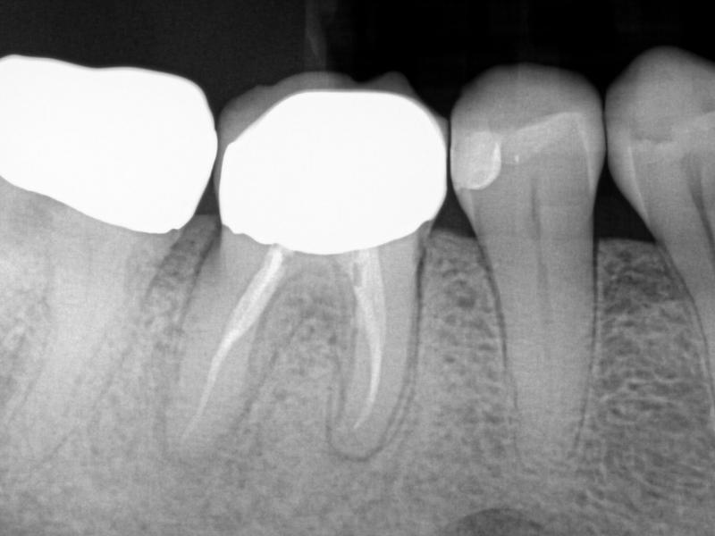 guarded-pre-op-with-healing-evidence-post-gentlewave-procedure